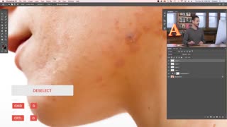 ۵ روش برای از بین بردن جوش صورت در فتوشاپ تزریق چربی