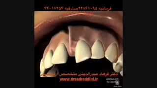 ارتودنسی فاصله دندان و جراحی لثه عصب‌کشی