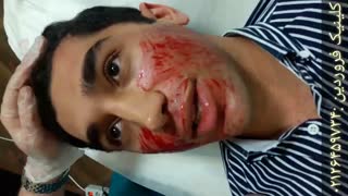 جوانسازی پوست با میکرونیدلینگ