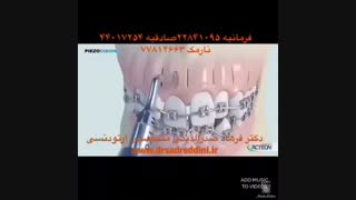 ارتودنسی سریع | دکتر فرهاد صدرالدینی برداشتن خال