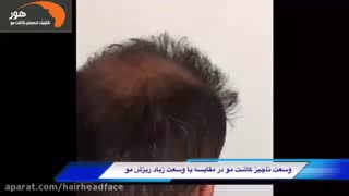 کاشت مو | کاشت مو در اصفهان | پیوند مو | کاشت موی طبیعی