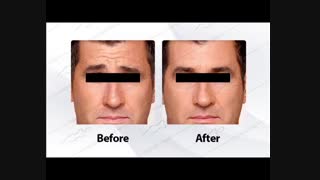 تزریق بوتاکس کلینیک پوست