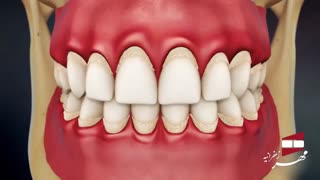 انیمیشن بیماری ژنژویت | کلینیک دندانپزشکی مهر زعفرانیه