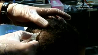 کربوکسی تراپی موی سر دکتر پوست