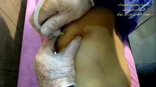 کربوکسی تراپی پهلو کلینیک مو
