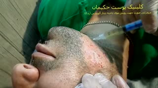 مزوتراپی جهت رفع ریزش موی سکه ای