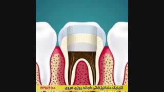 عصب کشی و ترمیم دندان