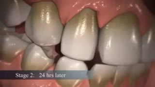 باکتری ها و پلاک های دندانی