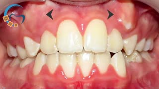 قبل و بعد ارتودنسی | دکتر مسعود داوودیان