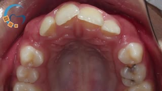 ارتودنسی پیشگیری | دکتر مسعود داوودیان لیزر صورت