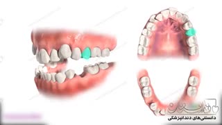 انیمیشن کشیدن دندان در ارتودنسی | دندانستان