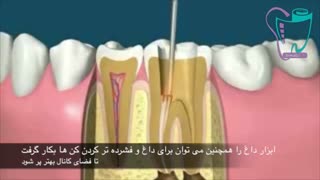 عصب کشی دندان | سیمادنت
