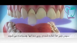 لمینت دندان | سیمادنت