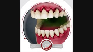 انیمیشن پریودنتیت (بیماری پیشرفته لثه) | دکتر اشکان مصطفی نژاد