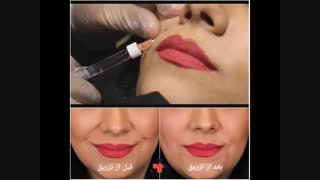 اصلاح خط لبخند با تزریق ژل