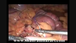 رزکسیون لاپاروسکوپیک یک لنفانژیوم کیستیک بسیار بزرگ