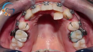 کشیدن دندان در ارتودنسی | دکتر مسعود داودیان