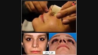 نمونه بینی جراحی شده بلافاصله بعد از برداشت اسپلینت