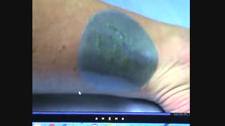 کاربردهای لیزر آلکس -دکتر مقیمی