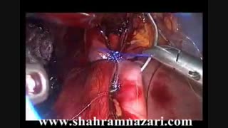 نیسن فوندوپلیکیشن در درمان ریفلاکس دربیماری با سایتوس اینورسوس