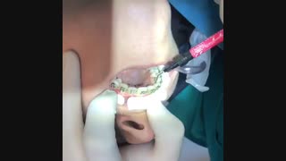 نحوه چسباندن سیم نگهدارنده ثابت ( فیکس)