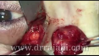 تومور اربیت