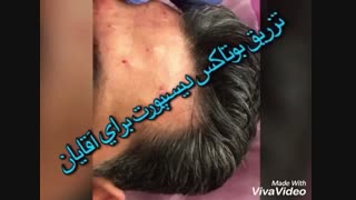 تزریق بوتاکس پیلینگ