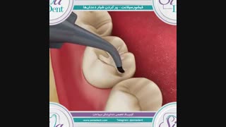 انیمیشن فیشور سیلانت | دندانپزشکی سیمادنت