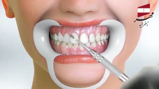 طراحی لبخند | کلینیک دندانپزشکی مهر زعفرانیه