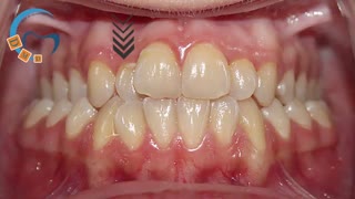 ارتودنسی دیمون بدون کشیدن دندان | دکتر مسعود داوودیان
