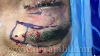 بازسازی ابرو