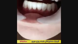 فیلم ونیر دندان