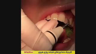 تمیز کردن دندان ها در دندانپزشکی