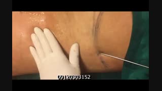 لیپوماتیک - دکتر ابدالی - 22807060 ابرسانی پوست