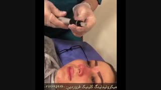 میکرونیدلینگ دور چشم