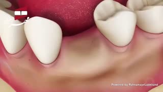 تحلیل استخوان فک | کلینیک دندانپزشکی مهر زعفرانیه