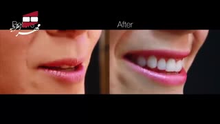 کامپوزیت ونیر | کلینیک دندانپزشکی مهر زعفرانیه
