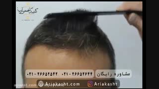 نمونه کاشت مو
