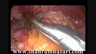 دیسکسیون لنفاوی حین جراحی سرطان معده: اطراف شریان معده راست