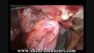 آپاندیسیت حاد