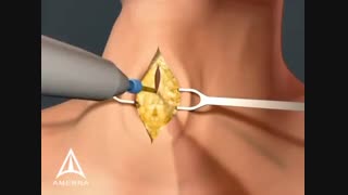 انیمیشن آموزشی تراکئوستومی