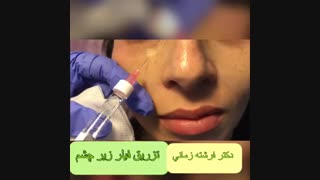 رفع گودی زیر چشم با تزریق فیلر