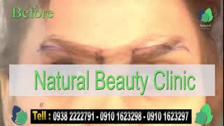 نمونه کار کاشت ابرو- قبل و بعد از کاشت!- نچرال بیوتی
