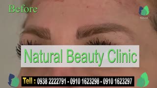 نمونه کار کاشت ابرو- قبل و بعد از کاشت!- نچرال بیوتی