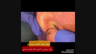 تخلیه جوش های سرسیاه و زیر پوستی