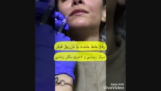رفع خط خنده با تزریق ژل هیالورونیک اسید