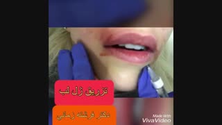 برجسته سازی طبیعی لب