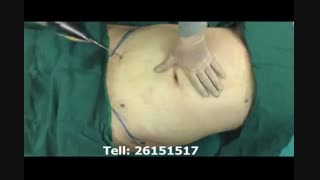 لیپوماتیک - دکتر ابدالی - 22807060 پلاستیک لثه