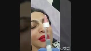 بلافاصله بعد از تزریق فیلر برای رفع گودی زیرچشم