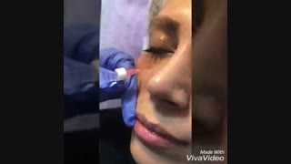 رفع گودی زیر چشم با تزریق فیلر